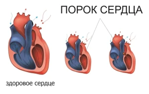 Причины возникновения пороков сердца